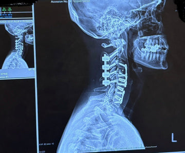 best pillow after cervical fusion surgery as noted by this patient's experience after her c2-ct anterior/posterior surgery. crown lift helped support her neck after hers